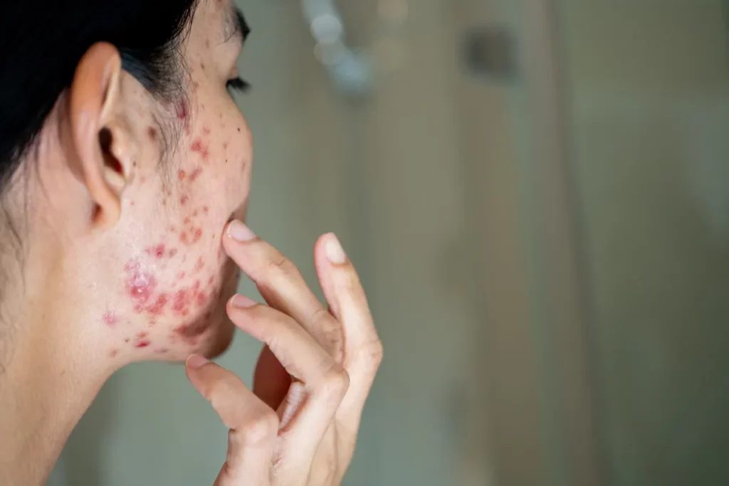 Ujęcie policzka z trądzikiem hormonalnym u młodej dziewczyny