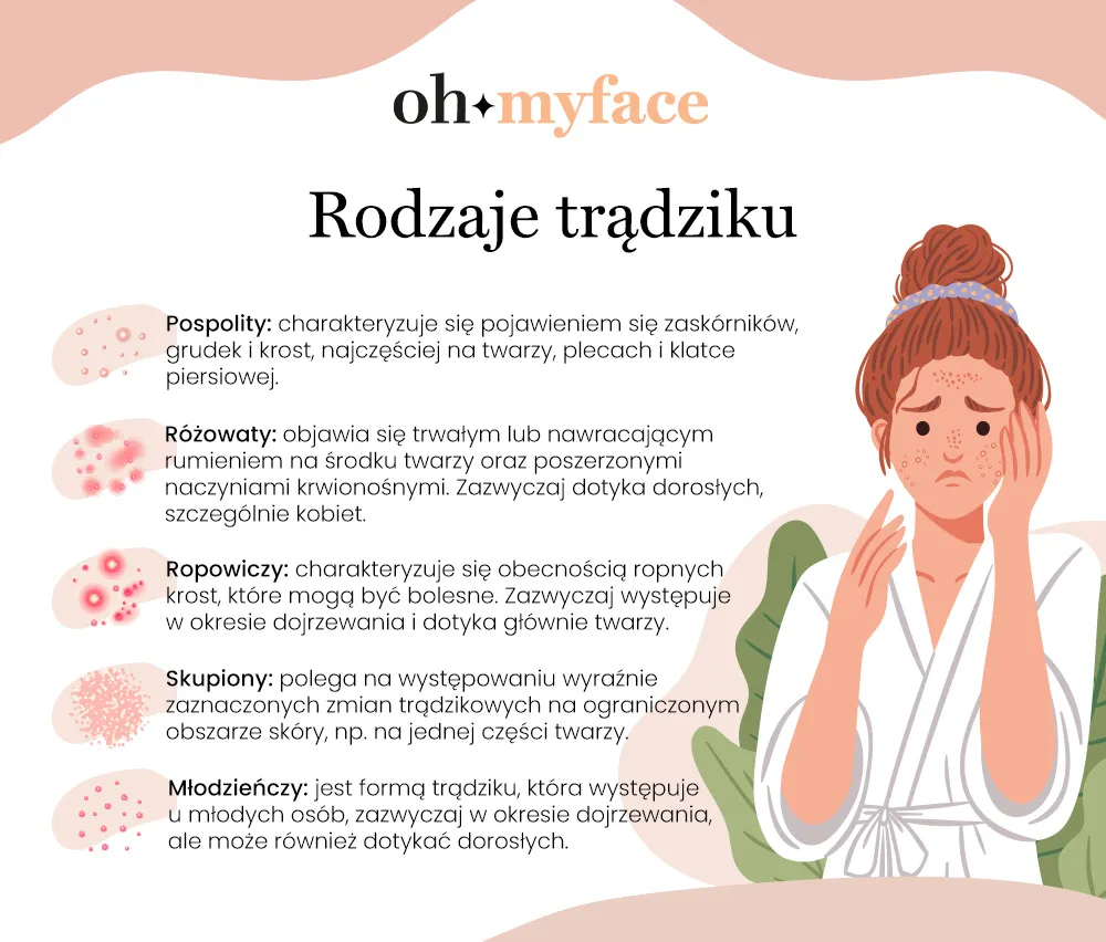 Infografika Oh My Face o rodzajach trądziku