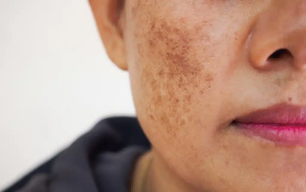 Melasma (ostuda) na policzkach 