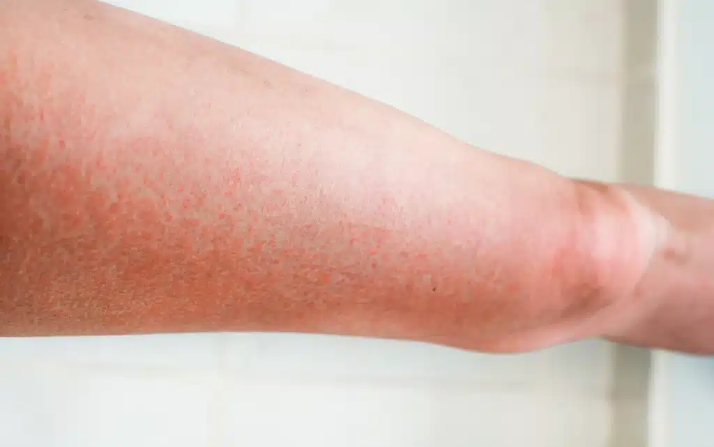Alergia na słońce – pokrzywka na nodze  